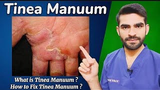 Tinea Manuum in urdu hindi  causes diagnosis treatment amp prevention [upl. by Donall]