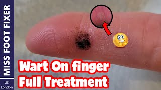 wart on finger full Treatment  after Treatment Updates Too By Miss Foot Fixer [upl. by Reeta]