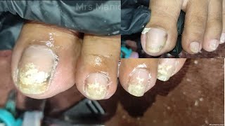 Vlog 1052Dry SkinIngrown Removal PEDICURE 952 [upl. by Llertnac]