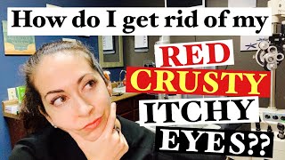 Blepharitis  2 Easy steps to banish red crusty itchy eyes  The Eye Surgeon [upl. by Bealle]