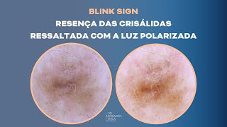 Blink Sign  Estruturas dermatoscópicas e sua relação com a luz não polarizada e polarizada [upl. by Ellekcir]