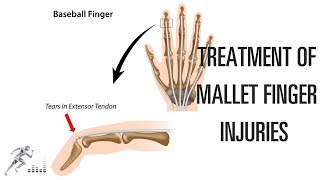 Mallet finger Treatment of this difficult finger injury [upl. by Franek540]