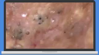 Punti Neri Acne blackheads Removal pt3 [upl. by Atinram]