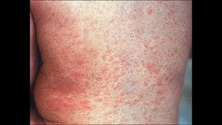 The causes and treatment of Roseola [upl. by Indnahc]