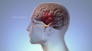 What Happens In Your Body During Migraine  WebMD [upl. by Liggett648]