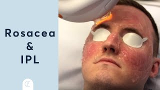 Rosacea Treatment at Pulse Light Clinic London [upl. by Atiragram]