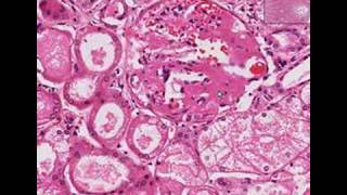 Histopathology Kidney Amyloidosis [upl. by Cosette]