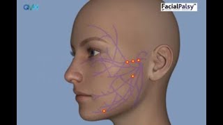 Understanding Facial Palsy [upl. by Garcia453]