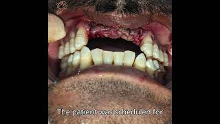 Dental implant Video  Best dental implant in Bangalore [upl. by Radec]