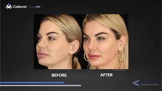 Cellenis Derma PRP Before amp After Pictures [upl. by Jala572]