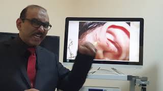 Preauricular sinus Malayalam Patient teaching programme [upl. by Hollah]