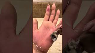 LEFT HAND RASP SHAVE  June 19 2023  Palmoplantar Keratoderma EPPK hand callus removal [upl. by Christianna]