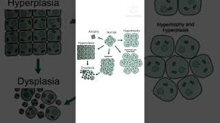 nursingmcq nursingcompetitiveexam nursingofficermcq cellular adaptation MetaplasiaDysplasia [upl. by Keele]