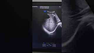 ultrasonography sonography ultrasound video viralvideo [upl. by Salohcim]