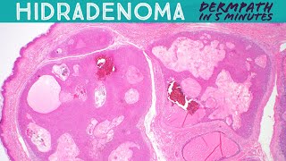 Hidradenoma Acrospiroma Dermpath in 5 Minutes Pathology Dermatology Dermatopathology [upl. by Dnana]