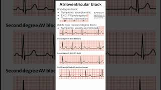 Atrioventricular block [upl. by Ahseik]