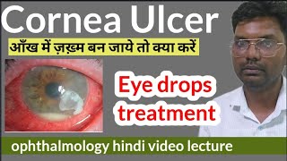 cornea ulcer treatment  cornea foreign body  corneal ulcer treatment  cornea ulcer eye drops [upl. by Jezebel]