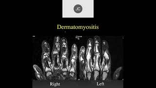 MRI of the Wrist Part 15  Wrist Inflammation [upl. by Annayi757]