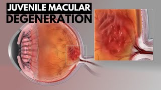 Juvenile Macular Degeneration Causes Symptoms and Treatment [upl. by Nohsar]