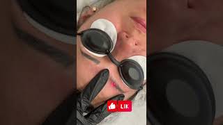 Laser eyebrows removal [upl. by Taveda731]