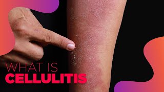 What is Cellulitis  Symptoms and Treatment Options [upl. by Calore329]