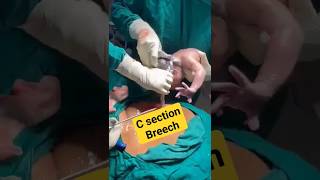 c sectionbreech deliverybaby birthshortsvideo [upl. by Ivah457]