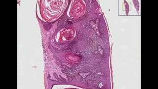 Histopathology Skin Seborrheic keratosis [upl. by Drews]