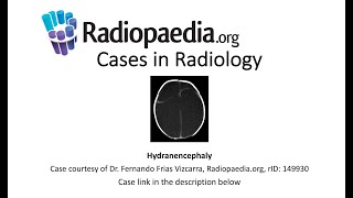 Hydranencephaly Radiopaediaorg Cases in Radiology [upl. by Phebe]