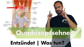 Quadrizepssehnenentzündung  Ursache amp Speziallösung [upl. by Auos]