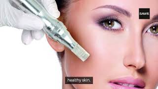 SkinPen Microneedling for Acne Scars in dallastx  Smooth and Revitalize Your Skin [upl. by Kepner]