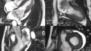 Cardiac MRI Myxoma [upl. by Euginomod]