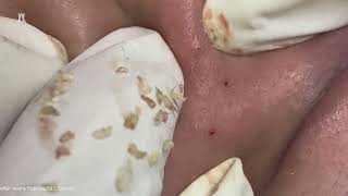 Big Cystic Acne Blackheads Extraction Blackheads amp Milia Whiteheads Removal Pimple Popping [upl. by Tnecnev]