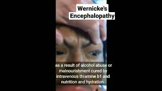 Wernickes Encephalopathy [upl. by Tom]