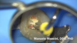 Dr Manuele Mancini  Endodonzia Primo Molare Superiore  Endodontics Upper First Molar [upl. by Amalburga944]