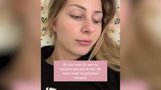 Rhinoplasty at the Wellness Kliniek  My experience [upl. by Munro246]