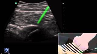 Démo 3D  infiltration échoguidée de lenthèse des ischiojambiers  Échographe SonoSite [upl. by Duahsar]