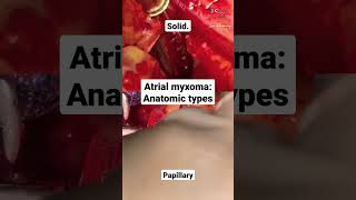 Atrial myxoma anatomic types [upl. by Eseneg183]