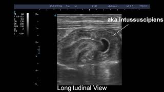 Intussusception  Point of Care USG demonstration [upl. by Valentin]