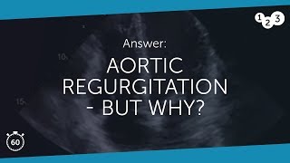 60 Seconds of Echo Teaching Answer Aortic regurgitation  but why [upl. by Shira166]