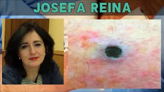 What Happened to Josefa Reina Dr ER Russ Hamstring and Karma Blackheads [upl. by Amuwkuhc]