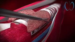 3D Medical Animation  TOETVA TransOral Endoscopic Thyroidectomy Vestibular Approach [upl. by Yrot528]