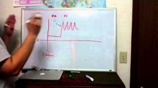 Haemodynamics Part 8 inserting a PA Cath [upl. by Illoh]