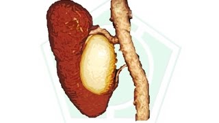 Ectasia pielocalicial Renal izquierda [upl. by Zzabahs]