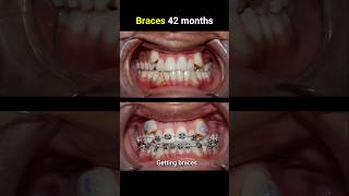 42 months for this braces casr braces orthodontist bracesoff bracesbeforeandafter [upl. by Imaon]