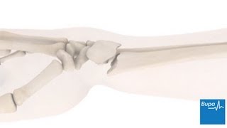 How a wrist fracture is treated  Bupa Health [upl. by Arabel]