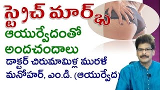 Stretch Marks  Home Remedies  Telugu  Dr Murali Manohar Chirumamilla MD Ayurveda [upl. by Steinman]