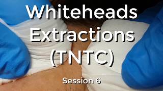 Whiteheads Extraction TNTC  Session 6 [upl. by Lothaire]