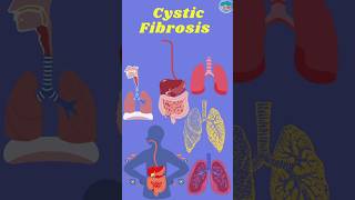 Cystic Fibrosis Mechanism Development Management and Treatment cysticfibrosis cystic [upl. by Mauchi8]