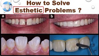 How to Solve Dental Esthetic Problems [upl. by Srevart]