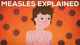 Measles Explained — Vaccinate or Not [upl. by Yeslek485]